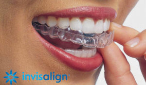 Clear Aligners Invisalign