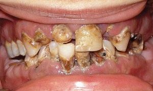 Effects of soda on teeth