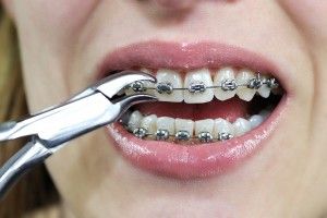 woman with braces