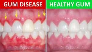 gum disease vs healthy gums
