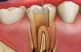 Root canal treatment