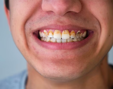 Methamphetamine Affected Teeth